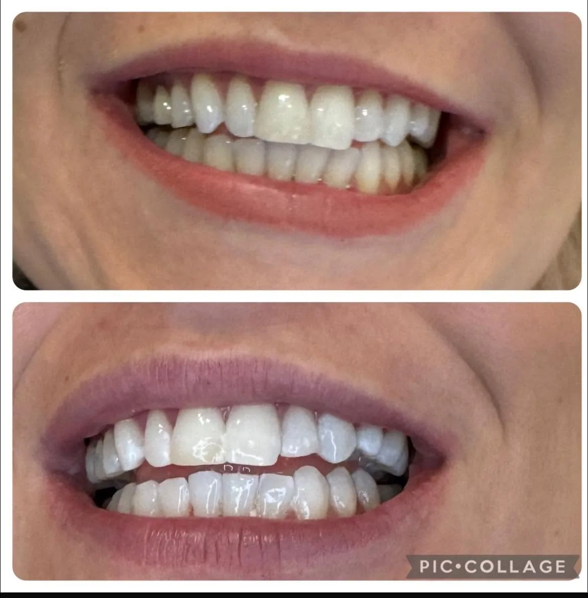 Teeth before and after