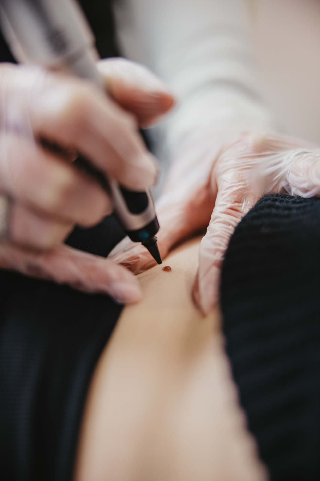 CryoPen Cryotherapy Training