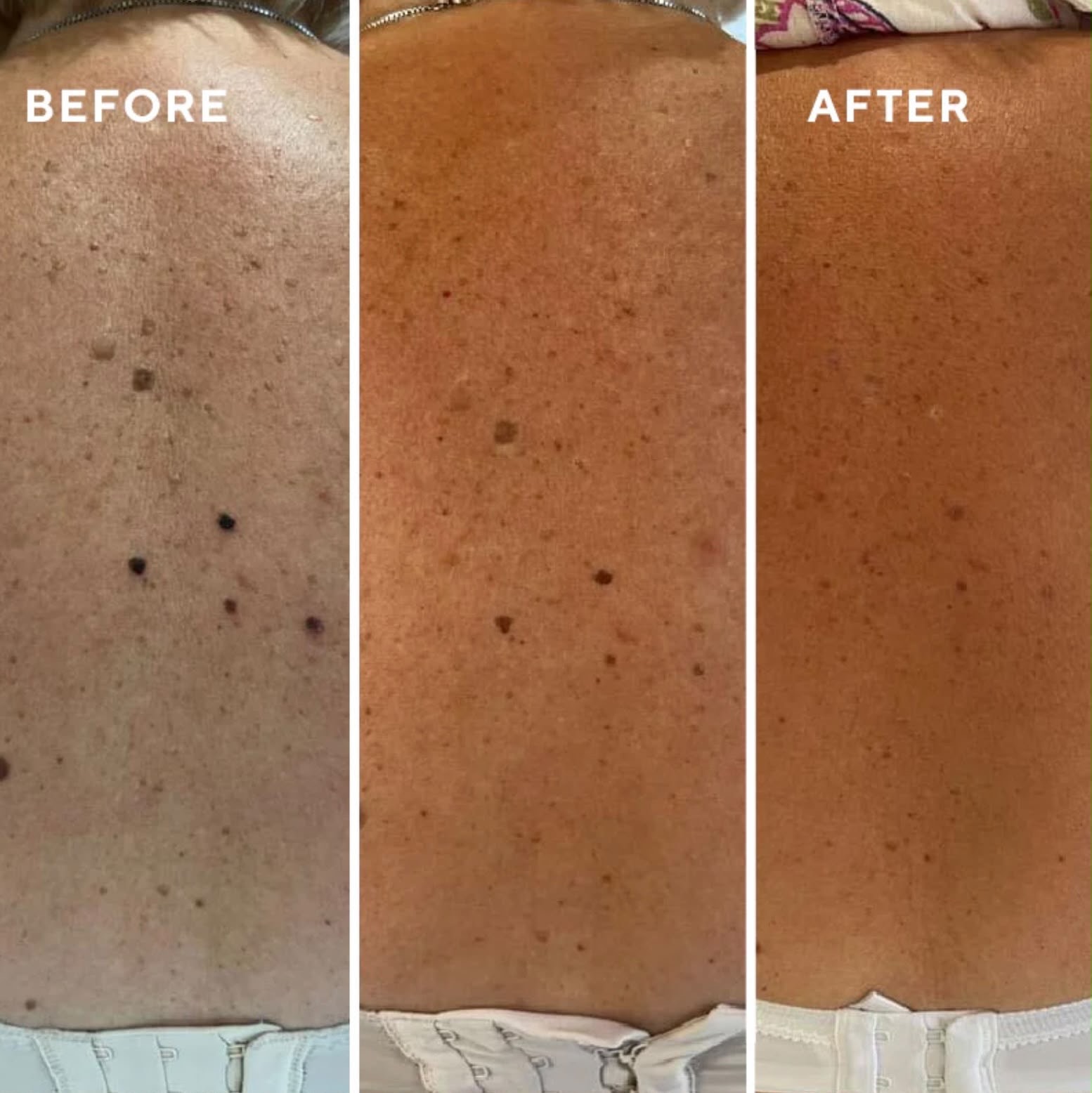 Lesion removal: back before and after