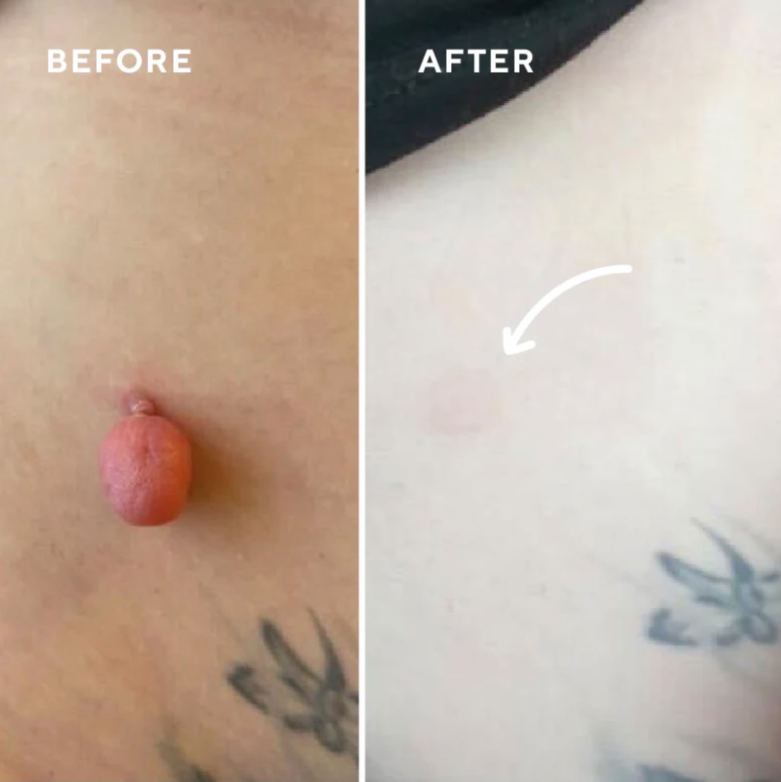 Lesion removal: before and after