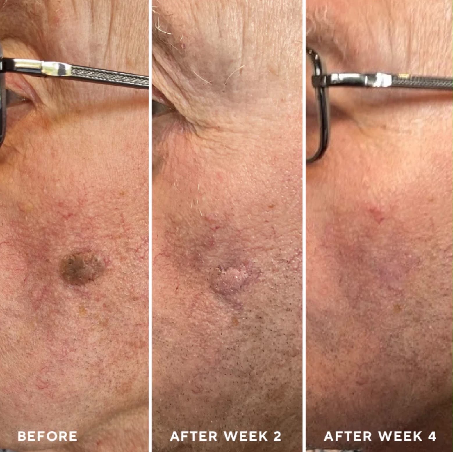 Lesion removal: before, week 2 and week 4