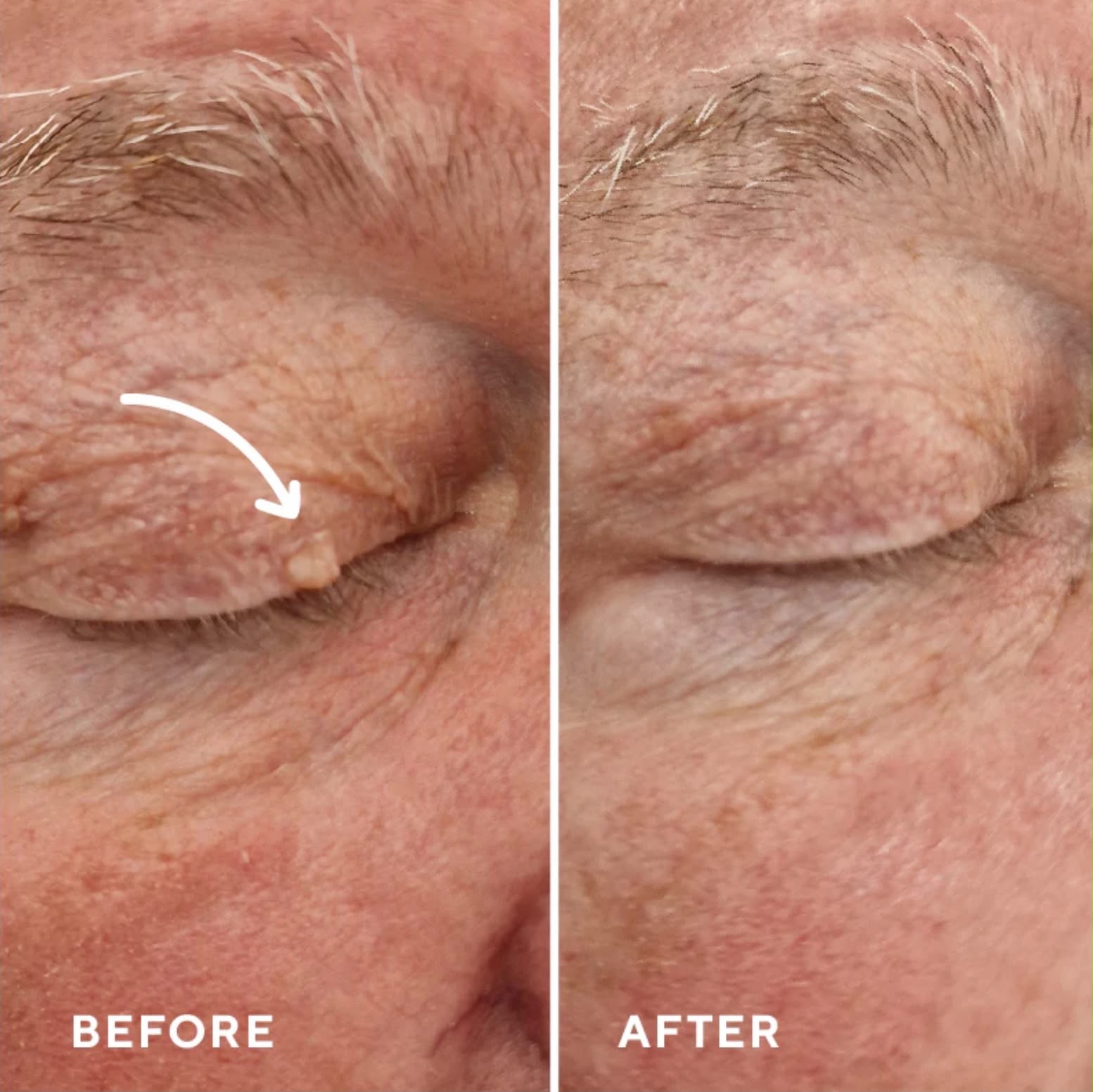 Lesion removal: eyelid before and after